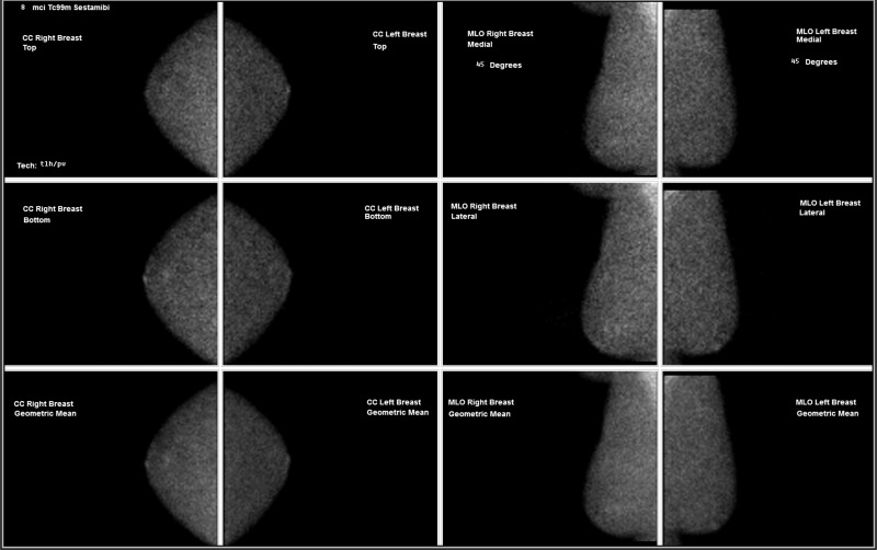 Images in a 64-year-old woman with (a) new grouping of calcifications in left breast (circled, coned magnification craniocaudal [CC]) but (b) with negative result at molecular breast imaging. No change on first short-interval follow-up (not shown); increased calcifications in the grouping 1 year later (not shown) led to stereotactic biopsy, results of which were negative for cancer.