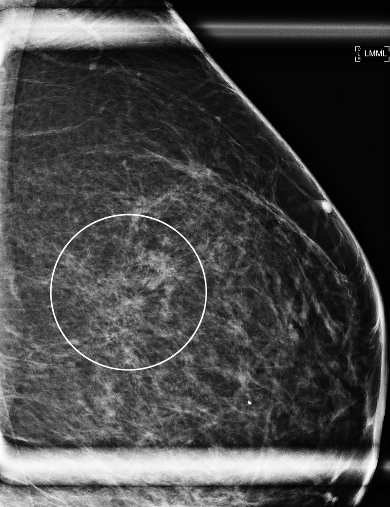 Images in a 55-year-old woman with (a) distortion in left breast (circle, coned magnification mediolateral oblique [MLO]) but (b) with negative molecular breast imaging. The faint activity seen on left craniocaudal (CC) of the molecular breast image was tissue bunching. There was no US correlate. Subsequent mammograms remained negative for 3 years.