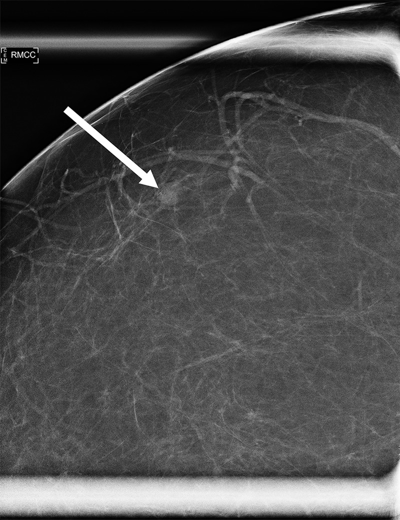 Images in a 64-year-old woman. (a) The mammogram shows a new mass in the lateral right breast (arrow, coned magnification craniocaudal [CC] view). There is no US correlate. (b) The MBI result is negative. The mammogram remained stable for 2 years. MBI = molecular breast imaging, MLO = mediolateral oblique.