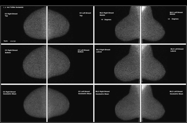 Images in a 64-year-old woman. (a) The mammogram shows a new mass in the lateral right breast (arrow, coned magnification craniocaudal [CC] view). There is no US correlate. (b) The MBI result is negative. The mammogram remained stable for 2 years. MBI = molecular breast imaging, MLO = mediolateral oblique.