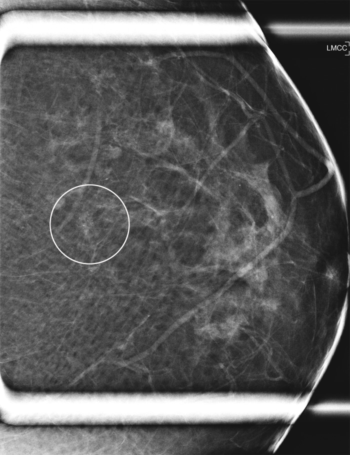 Images in a 64-year-old woman with (a) new grouping of calcifications in left breast (circled, coned magnification craniocaudal [CC]) but (b) with negative result at molecular breast imaging. No change on first short-interval follow-up (not shown); increased calcifications in the grouping 1 year later (not shown) led to stereotactic biopsy, results of which were negative for cancer.