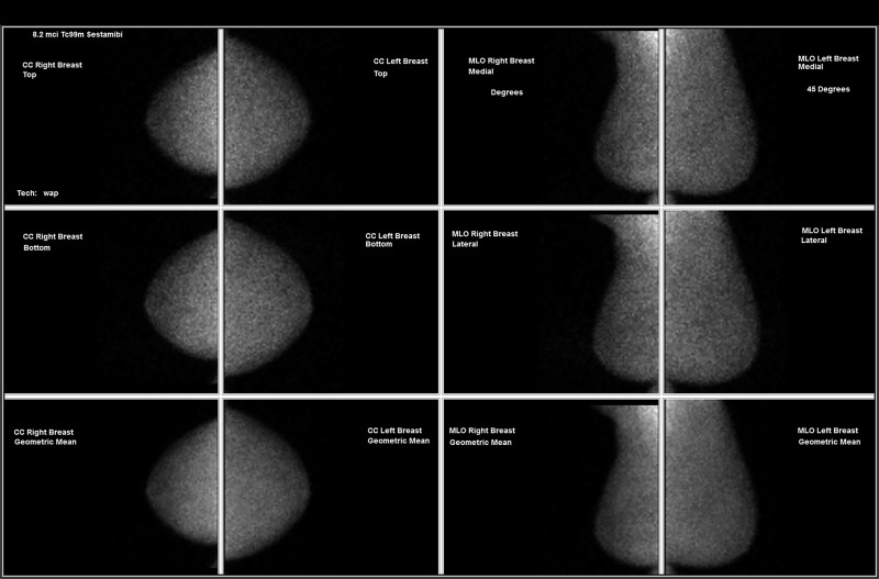 Images in a 71-year-old woman, after lumpectomy in the right breast. The mammogram in 2016 was negative. (a) US image obtained several days later shows a mass with posterior shadowing at eight o’clock position (arrow) in the left breast. (b) The molecular breast imaging result was negative. The subsequent MRI, mammographic, and US results were negative for 2 years. CC = craniocaudal, MLO = mediolateral oblique.