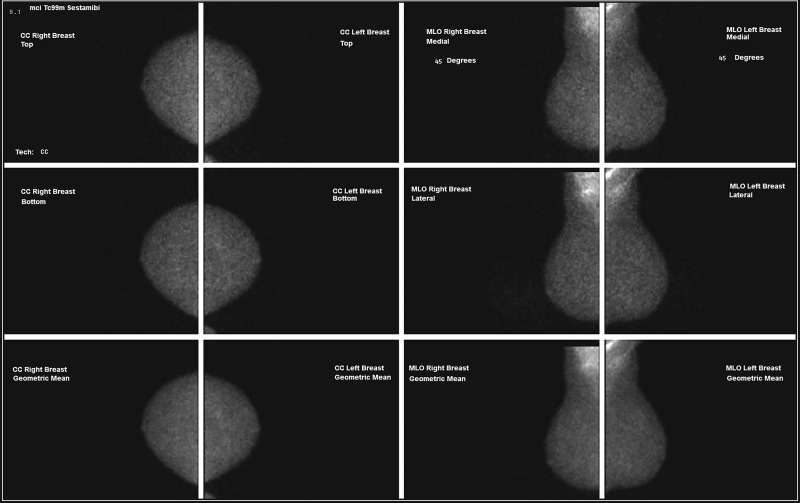 Images in a 55-year-old woman with (a) distortion in left breast (circle, coned magnification mediolateral oblique [MLO]) but (b) with negative molecular breast imaging. The faint activity seen on left craniocaudal (CC) of the molecular breast image was tissue bunching. There was no US correlate. Subsequent mammograms remained negative for 3 years.