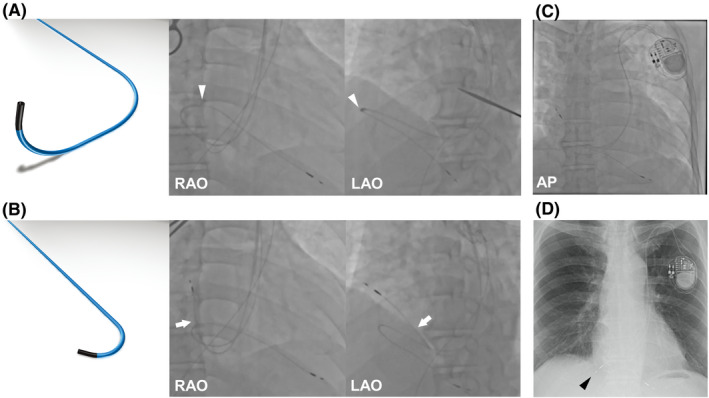 Pacemaker Implantation Using The Selectsecure System For A Patient With 