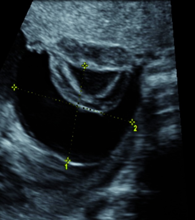 Prenatal diagnosis of multiple large subchorionic placental cysts with ...