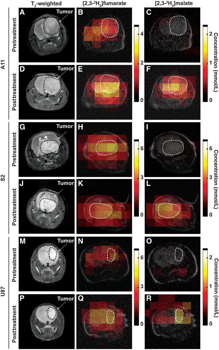 Figure 3. Representative metabolite concentration maps from the central slice derived from a series of dynamic 3D 2H CSI images summed over the first 30 minutes of signal acquisition following [2,3-2H2]fumarate injection into A11 (B, C, E, F), S2 (H, I, K, L), and U87 (N, O, Q, P) tumor-bearing mice. The color code represents concentration (in mmol/L) derived from the ratios of the peak intensities in the malate and fumarate maps to peak intensities in an initial HDO map and corrected for the number of 2H labels per molecule and for signal saturation. The locations of the tumors are indicated by dotted white lines determined from an underlying T2-weighted 1H image acquired concurrently using a 1H volume coil. The corresponding T2-weighted 1H images were acquired separately at 9.4 T. The tumor locations are outlined with dotted black lines. T2-weighted 1H images (A, G, M) and the fumarate (B, H, N) and malate (C, I, O) concentration maps pretreatment and the corresponding T2-weighted 1H images (D, J, P) and the fumarate (E, K, Q) and malate (F, L, R) concentration maps 48 hours following the last chemo-radiotherapy treatment.