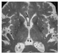 Assessment of Microvascular Disease in Heart and Brain by MRI ...