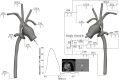 Schematic illustration of a systems approach to cardiovascular fluid mechanics simulations via advanced boundary conditions often used with computational growth, and remodeling studies. Left: an open-loop approach is shown with discretized model geometry and an ascending aorta flow waveform extracted from patient phase contrast MRI (PC-MRI) data imposed at the inlet, and three-element Windkessel representations applied at outlets. Outlets shown include the right (RSA) and left (LSA) subclavian arteries, right (RCA) and left (LCCA) common carotid arteries, right (RPA) and left (LPA) pulmonary arteries, and descending thoracic aorta (DAo). Right: a closed-loop lumped parameter network is shown with a single ventricle cardiac model coupled to the discretized model geometry. In addition to model outlets, the closed-loop representation includes the left pulmonary bed (LPB), right pulmonary bed (RPB), lower body bed (LBB), upper body bed (UBB), as well as a single ventricle cardiac model. Adapted from Blanch-Granada et al. [136].