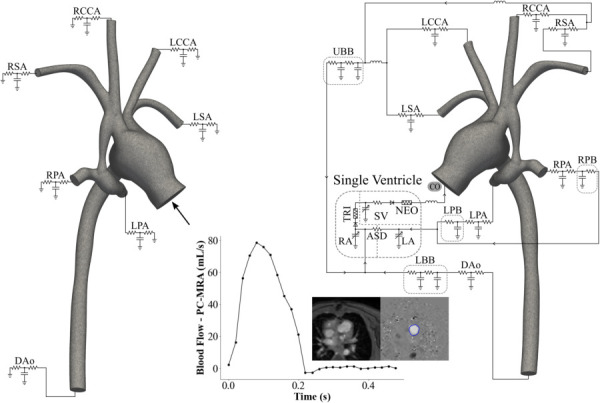 Schematic illustration of a systems approach to cardiovascular fluid mechanics simulations via advanced boundary conditions often used with computational growth, and remodeling studies. Left: an open-loop approach is shown with discretized model geometry and an ascending aorta flow waveform extracted from patient phase contrast MRI (PC-MRI) data imposed at the inlet, and three-element Windkessel representations applied at outlets. Outlets shown include the right (RSA) and left (LSA) subclavian arteries, right (RCA) and left (LCCA) common carotid arteries, right (RPA) and left (LPA) pulmonary arteries, and descending thoracic aorta (DAo). Right: a closed-loop lumped parameter network is shown with a single ventricle cardiac model coupled to the discretized model geometry. In addition to model outlets, the closed-loop representation includes the left pulmonary bed (LPB), right pulmonary bed (RPB), lower body bed (LBB), upper body bed (UBB), as well as a single ventricle cardiac model. Adapted from Blanch-Granada et al. [136].