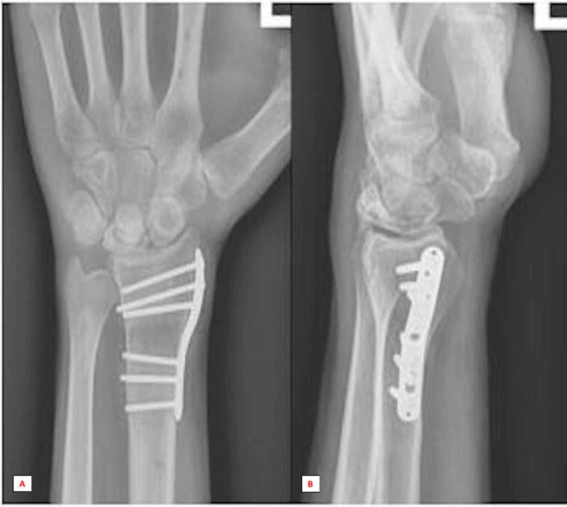 Repetitive Microtrauma and Negative Ulnar Variance as Possible Culprits ...