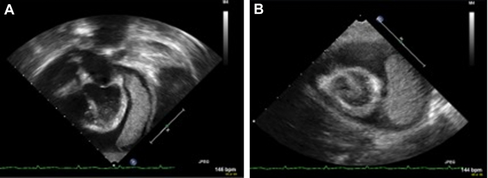 Surgical and Medical Management of Purulent Bacterial Pericarditis With ...