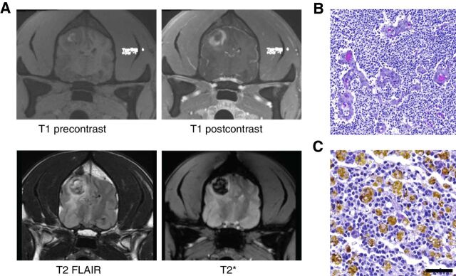 Figure 3. A, Dog 4 showing radiographic progression 15 weeks after second injection of IACS-8779. Top row and from left to right: T1 precontrast and postcontrast. Bottom row, left to right: T2 FLAIR and T2*. Note dark signal on T2 consistent with hemosiderin deposition in the tumor. B, Hematoxylin and eosin images of glioblastoma with microvascular proliferation at 100× magnification (scale bar = 100 μm). C, Hemosiderin laden macrophages at 200× magnification (scale bar = 50 μm).