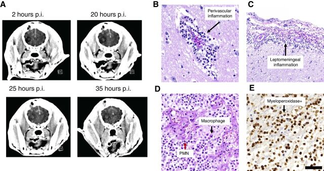 Figure 4. A, Dog 5 demonstrating progressive midline shift and brain edema post injection of 15 μg IAC-8779. Post-injection, p.i. B, Hematoxylin and eosin images demonstrating an acute perivascular inflammatory response at 200× magnification (scale bar = 50 μm). C, Leptomeningeal inflammatory response at 100× magnification (scale bar = 100 μm). D, In the region of glioblastoma, there was diffuse infiltrating polynuclear mononuclear cells (PMN; example designated by red arrow) and macrophages (example designated by black arrow) at 200× magnification (scale bar = 50 μm). E, The inflammation within the tumor shows positive myeloperoxidase stain at 200× magnification (scale bar = 50 μm).