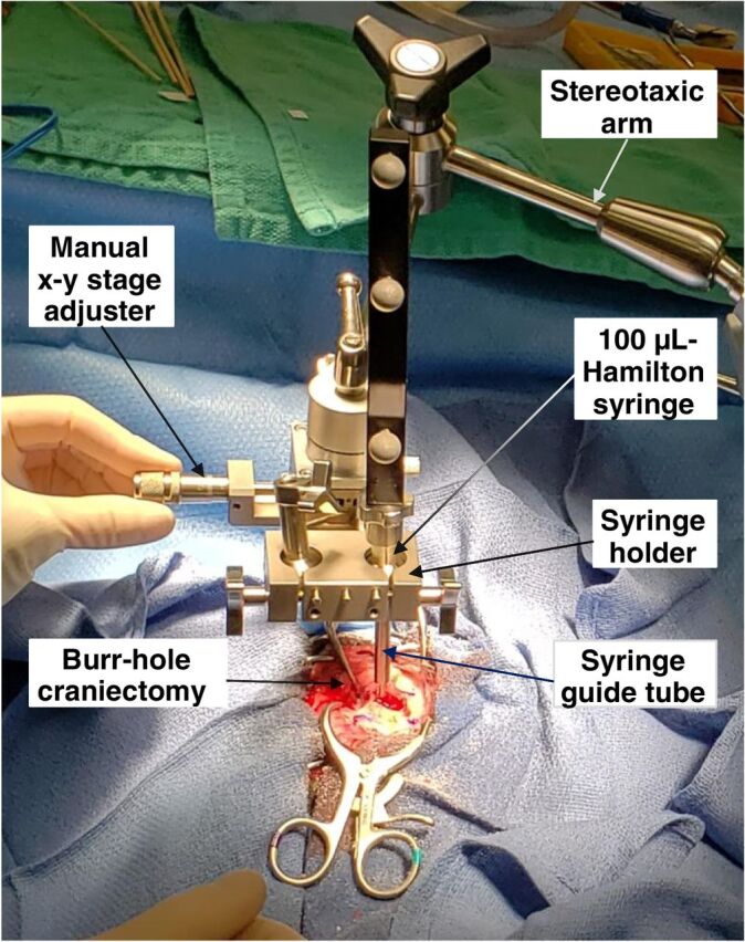 Figure 1. Intraoperative image of direct intratumoral administration of IACS-8779 using navigational guidance.