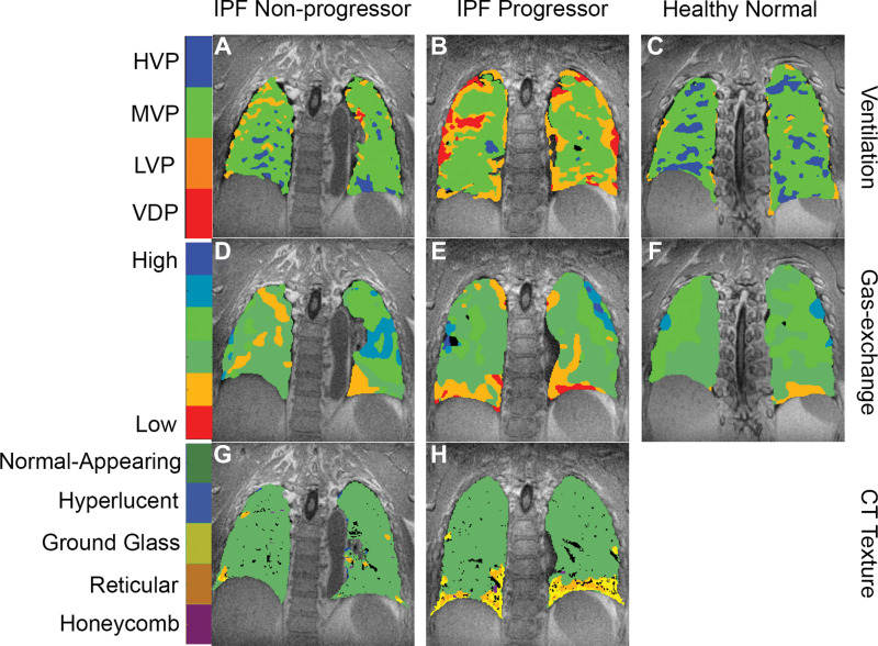 Hyperpolarized xenon 129 (129Xe) MRI and quantitative texture on chest CT images in three typical participants. In a 68-year-old man with nonprogressive idiopathic pulmonary fibrosis (IPF), (A) 129Xe ventilation, (D) 129Xe gas exchange, and (G) CT-based texture images are shown. In a 65-year-old man with progressive IPF, (B) 129Xe ventilation, (E) 129Xe gas exchange, and (H) CT-based texture images are shown. In a 63-year-old healthy man, (C) 129Xe ventilation and (F) 129Xe gas exchange images are shown. CT data were not acquired in the healthy volunteer. Note the progressively poorer ventilation and gas exchange going from healthy volunteer to nonprogressor to progressor, and the increased prevalence of fibrotic textures in the participant with progressive IPF. HVP = high-ventilation percent, LVP = low-ventilation percent, MVP = medium-ventilation percent, VDP = ventilation defect percent.