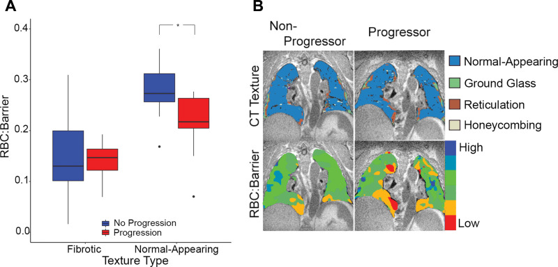 (A) Box plots of the red blood cell (RBC)-to-barrier ratio in fibrotic and normal-appearing lung in progressor and nonprogressor groups. * Statistically significant difference. Note the overall reduced RBC-to-barrier ratio in fibrotic lung and the difference in progression groups in the normal-appearing lung (P = .01) but not in the fibrotic lung (P = .67). (B) Images in a 77-year-old man with idiopathic pulmonary fibrosis (IPF) from the nonprogressor group (left) and a 77-year-old man with IPF from the progressor group (right) show exemplary differences demonstrated on the box plots (A). Note that RBC-to-barrier ratio is uniformly low in fibrotic regions on CT images but also reduced in normal-appearing regions, and more prominently in the participant with progressive IPF.