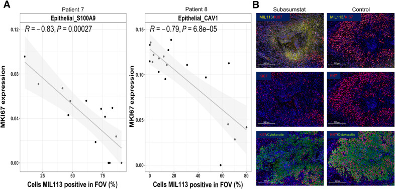 Figure 6. Subasumstat target engagement is specifically associated with a reduction in markers of cell-cycle progression in malignant epithelial cells from patients 7 and 8. A, Correlation of MKI67 expression to drug target engagement measured by the percentage of cells MIL113-positive in Epithelial_S100A9 cells (patient 7) and Epithelial_CAV1 cells (patient 8), respectively. Linear models were fit and are shown with associated Pearson correlation, P value, as well as 95% confidence intervals (shaded). B, Immunofluorescent staining for subasumstat-SUMO adducts (MIL113, yellow), cell proliferation marker KI67 (red), and tumor cell marker (cytokeratin, green) showing the reduction in proliferating tumor epithelium in regions of subasumstat drug target engagement compared with a directly adjacent uninjected region, no drug control; scale bar, 500 μm.