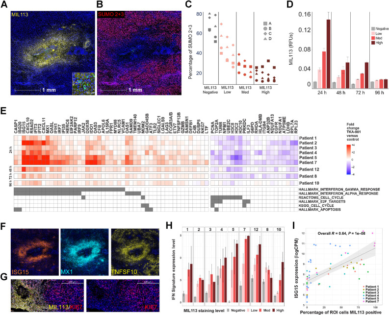 Figure 2. Microinjection of subasumstat with CIVO induces exposure-dependent inhibition of SUMOylation, activation of an IFN response, and reduction of cell-cycle–associated gene expression across multiple tumors. A, A representative single CIVO site of subsumstat microinjection. MIL113 staining (yellow) tracks regions of target engagement (subasumstat-SUMO adduct formation) around the site of injection and demonstrates spatially localized distribution of drugs; scale bar, 1,000 μm. The original epicenter of the injection site is identified by the presence of fluorescent tracking microspheres (CIVO GLO green; inset; scale bar, 50 μm). B, The same site of localized subsumstat exposure as shown in (A) evaluated by IHC with an antibody specific for SUMO 2+3 (red) shows reduction in cells staining positive for this proximal biomarker of SUMOylation pathway activity. C, Quantification of the percentage of cells staining positive for SUMO2+3 shows an inverse relationship between level of subasumstat target engagement (MIL113 staining) and SUMOylation (%SUMO 2+3 positive). D, MIL113 staining intensity for four binned categories (negative, low, medium, and high) for tumors processed at different timepoints (24, 48, 72, and 96 hours). Error bars represent the standard error of the mean. E, Heat map of genes identified as responsive to subasumstat across nine individual tumors resected at different timepoints (24, 48, 72, and 96 hours). Linear models were fit to the data to account for different patients, slides, and injection sites and fold-change values extracted corresponding to the drug effect—subasumstat negative (negative) versus subasumstat-exposed (high, med, and low). Genes were selected if they showed a >1.5-fold change in expression between drug exposed and nonexposed ROI at Padj < 0.05 across eight of the nine patients (note patient 10 was excluded from this analysis because of weak signal at the late timepoint of 96 hours), with a consistent direction of change across all nine patients. The genes are annotated for membership of pathways identified by enrichment analysis using MSigDB (Supplementary Table S6A and S6B). F, Visualization of subasumstat-induced elevation of specific IFN response genes with ISH probes specific for ISG15 (orange), MX1 (cyan), and TNFSF10 (yellow). Note that these images are taken from the same region and the same scale as that shown for A and B. G, Visualization of subasumstat inhibition of cell cycle by dual IHC with MIL113 (yellow) and KI67 (red). Left and right panels are the same except the right panel has the channel for MIL113 staining removed to show the effect on KI67 staining; scale bar, 500 μm. H, The IFN signature score (level of signature expression) was determined for regions of high (n = 61), medium (n = 71), low (n = 55), or no MIL113 staining (n = 125). Signature scores are plotted by patient, and the level of subasumstat drug target engagement was determined by MIL113 stain intensity. Error bars represent the standard error of the mean. I, For each ROI analyzed via DSP, the relative expression of the highly IFN-responsive gene ISG15 is plotted as a function of percentage of cells that are MIL113-positive within the ROI. A linear model fit is shown with associated Pearson correlation, and P value as well as 95% confidence intervals (shaded). ISG15 expression levels are highly correlated with the percentage of cells exposed to subasumstat.