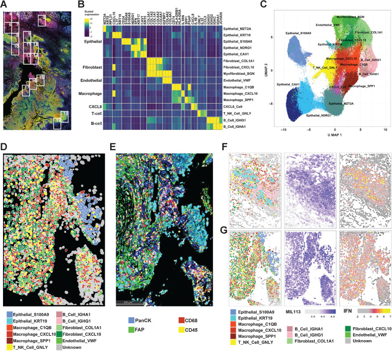 Figure 3. CosMx Spatial Imaging identifies subasumstat-responsive cells in CIVO microinjected tumors. A, Formalin-fixed, paraffin-embedded sections of tumor from patient 7 stained with DAPI, panCK, and MIL113 adjacent to the section used in the CosMx analysis. Boxes represent fields of view (FOV) collected. B, Differentially expressed genes used to identify cell types in UMAP clusters. Genes were identified for clusters from UMAP projection using the FindAllMarkers function in Seurat using parameters only.pos = TRUE, min.pct = 0.25, and logfc.threshold = 0.25. The top three genes for each cluster are shown (see Supplementary Fig. S8A for all genes and cells). Expression is the average for each cell type of the scaled gene level data across tumors 7 and 8. On the basis of the identity of the genes for each cluster a cell type was established by reference to established marker sets. C, UMAP projection of 16 cell types identified from clustering of data from patients 7 and 8. UMAP clustering was performed in Seurat using a standard workflow following data normalization and PCA. Cells (n = 93,491) are colored according to the cell identities from (B). D, Spatial reconstruction of patient 7: FOV 14. Cell identities are based on UMAP cluster (C). E, IHC staining of adjacent section to (D) showing distribution of immune cells (CD45), macrophages (CD68), epithelial cells (PanCK), and fibroblasts (FAP). F, Patient 7: FOV 2 representing adjacent normal tissue region containing salivary gland exposed to subasumstat showing reconstruction of cell types, MIL113 staining intensity, and IFN signature expression in respective panels. Note that the MIL113 staining data are from an adjacent section. G, Patient 7: FOV 14 representing a region of tumor cells exposed to subasumstat showing reconstruction of cell types, MIL113 staining intensity, and IFN signature expression in respective panels. Note that the MIL113 staining data are from an adjacent section.