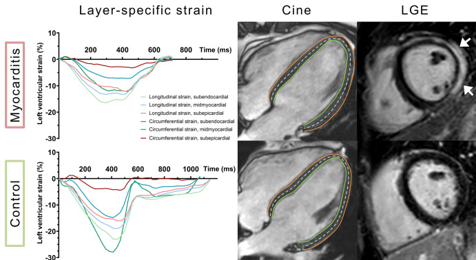 Cardiac MR images show a clinical example of a 39-year-old man with acute myocarditis (upper row) and a healthy control (lower row). Coordinate axes display layer-specific curves of left ventricular peak systolic global longitudinal and circumferential strain, indicating reduced values in the patient with myocarditis. Non–contrast-enhanced cine images in four-chamber view demonstrate manually drawn contours at the subendocardial border (green line) and the subepicardial border (red line), as well as a representative line of the midmyocardium (dashed blue line). Late gadolinium enhancement (LGE) imaging in short-axis view shows distinct subepicardial and midmyocardial enhancement of the left ventricular lateral wall (white arrows).