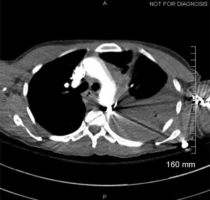 CTA Chest 1: