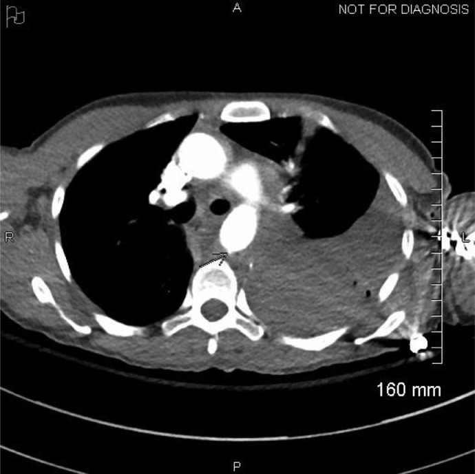 CTA Chest 2: