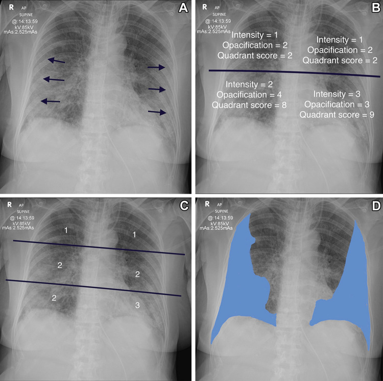 Determination of the various scoring systems. (A) Anteroposterior radiograph in 78-year-old woman shows the classic changes of COVID-19 pneumonitis, which consist of opacification in a peripheral and basal distribution (arrows). (B) Radiograph shows calculation of the radiographic assessment of lung edema (RALE) score. The radiograph is divided into four quadrants. Each quadrant is assigned an intensity score and an opacification score. These are multiplied together for each quadrant, and all four scores are added together. The patient has a RALE score of 21. (C) Radiograph shows calculation of the Brixia score. The lungs are divided into six zones, and the degree of opacification is scored as follows: interstitial opacities, interstitial and alveolar opacities (interstitial predominate), and interstitial and alveolar opacities (alveolar predominate), scored as 1, 2, and 3, respectively. The patient has a Brixia score of 11 (1 + 2 + 2 + 1 + 2 + 3). The highest possible Brixia score is 18. (D) Radiograph shows percentage opacification, a simple visual estimate of the total percentage of lung parenchymal opacification.