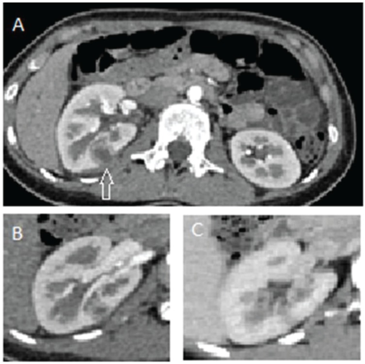 Acute Focal Bacterial Nephritis: Two Cases and Review of the Literature ...