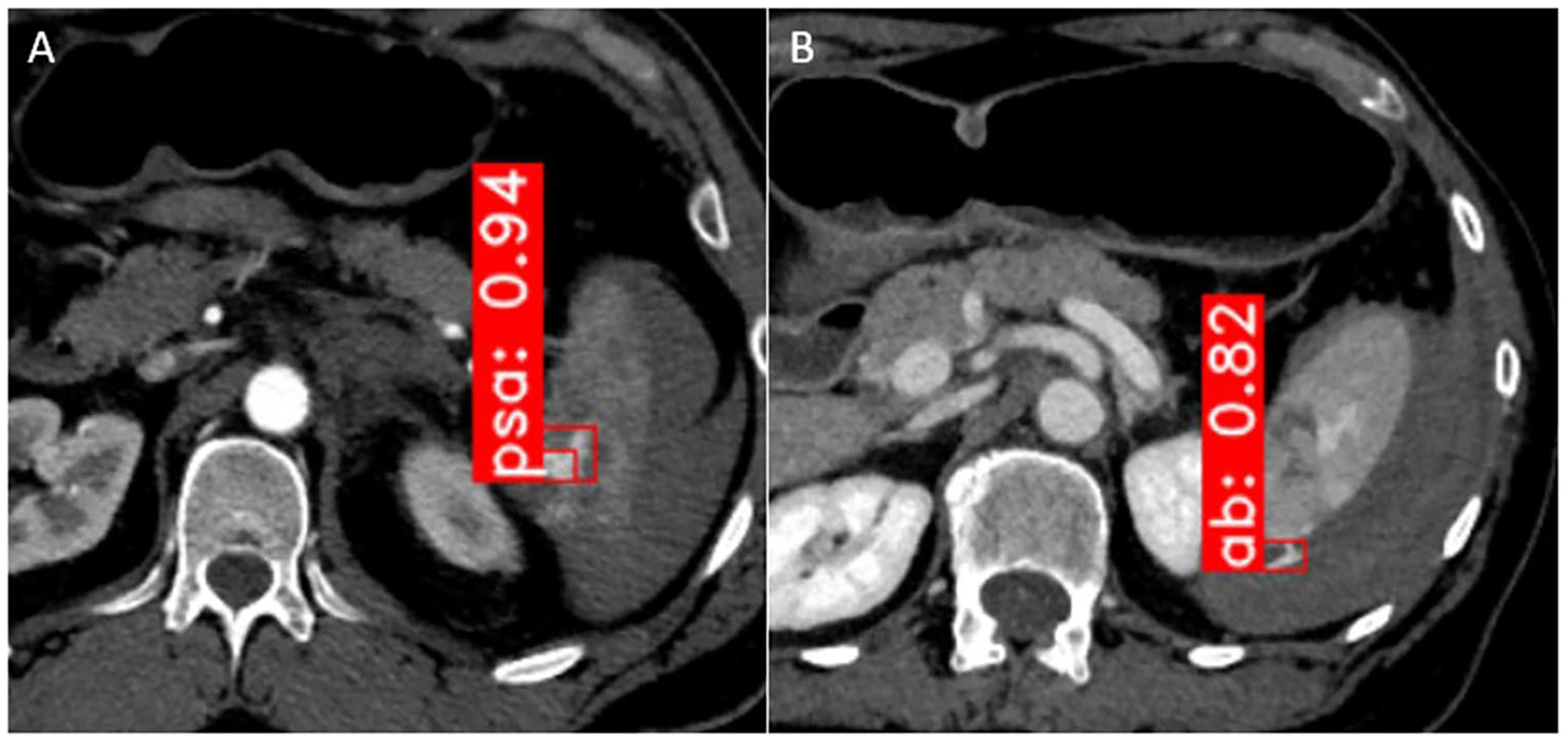 Toward automated interpretable AAST grading for blunt splenic injury - PMC