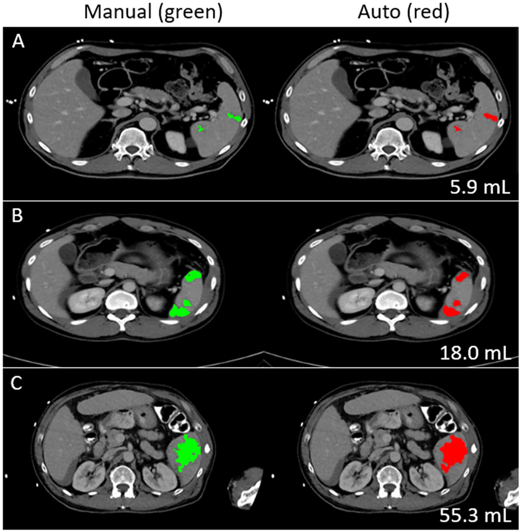 Toward automated interpretable AAST grading for blunt splenic injury - PMC