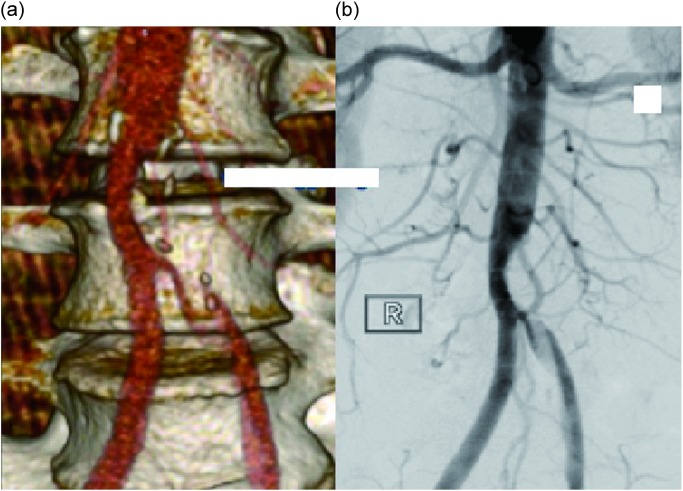 Fig. 1 DSA (a) and 3D CTA (b) reconstruction of infrarenal IAAD, extending to the left CIA.