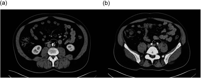 Fig. 2 Preoperative CTA showing infrarenal IAAD commencing at the level of the IMA and extending to the left CIA.