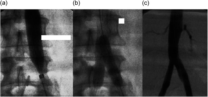 Fig. 3 Intraoperative angiography depicting (a) deployment of the aortic stent graft, (b) deployment of two iliac balloon expandable stents with the application of the kissing stents technique, (c) final angiography showing excellent patency of all involved vessels.