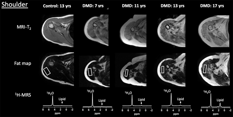 Example upper extremity MRI and proton (1H) MR spectroscopy (MRS) data acquired from the dominant (a) shoulder and (b) upper arm in control participants and participants with Duchenne muscular dystrophy (DMD) at different ages. Single voxel stimulated-echo acquisition mode 1H MR spectroscopy spectra were acquired at echo time of 27 msec from the deltoid (a) and biceps brachii (b).