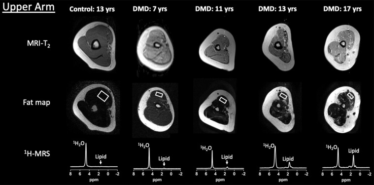 Example upper extremity MRI and proton (1H) MR spectroscopy (MRS) data acquired from the dominant (a) shoulder and (b) upper arm in control participants and participants with Duchenne muscular dystrophy (DMD) at different ages. Single voxel stimulated-echo acquisition mode 1H MR spectroscopy spectra were acquired at echo time of 27 msec from the deltoid (a) and biceps brachii (b).