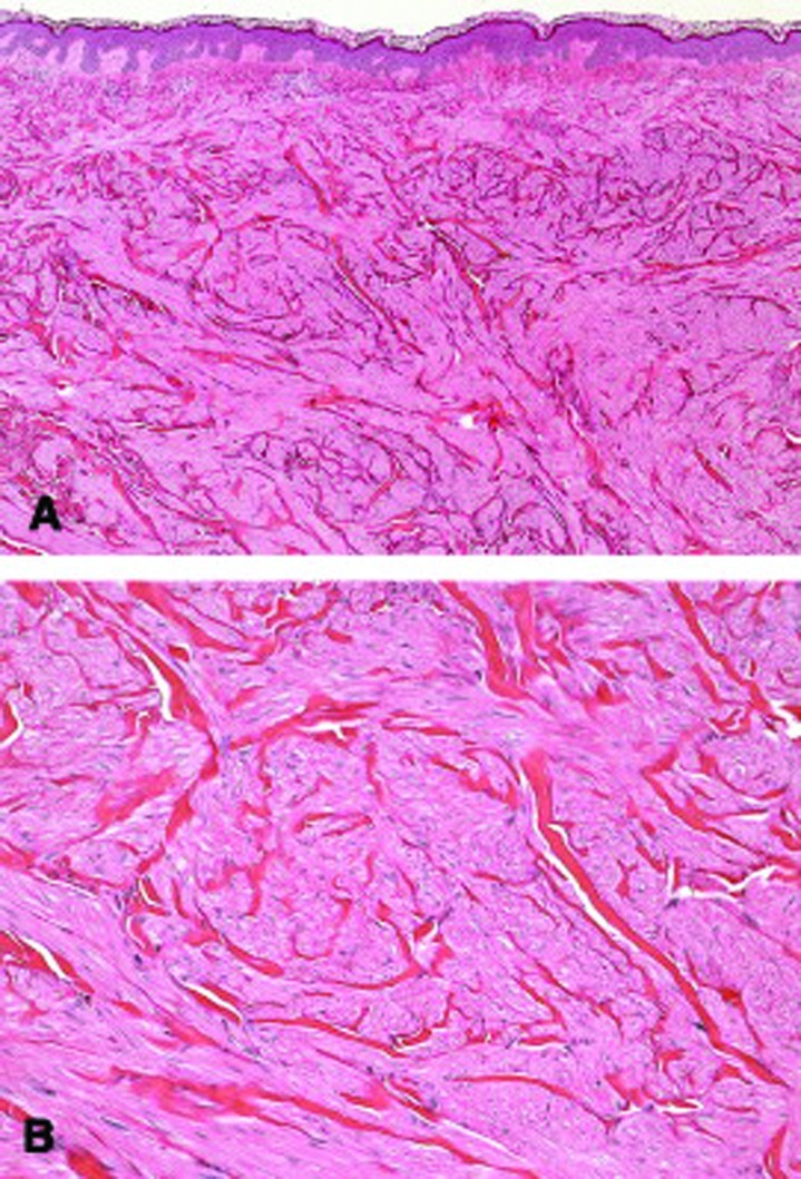 Multiple Cutaneous and Uterine Leiomyomatosis Syndrome: A Review - PMC