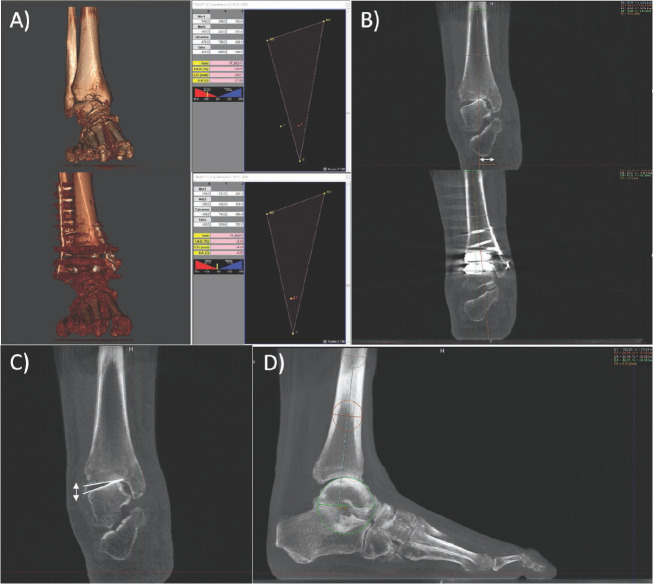 Deformity Correction In Ankle Osteoarthritis Using A Lateral Trans deformity-correction-in-ankle-osteoarthritis-using-a-lateral-trans