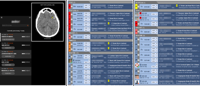 Screenshots show the visual display of an artificial intelligence finding in a production reading environment. Left panel: phase 1 with widget only. Center panel: phase 2 with yellow flag in a worklist. Right panel: phase 3 with yellow flag and reprioritization in a worklist.