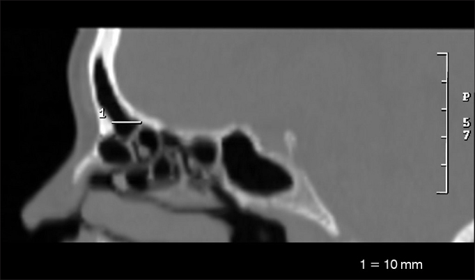 Analysis of the Agger nasi cell and frontal sinus ostium sizes using ...