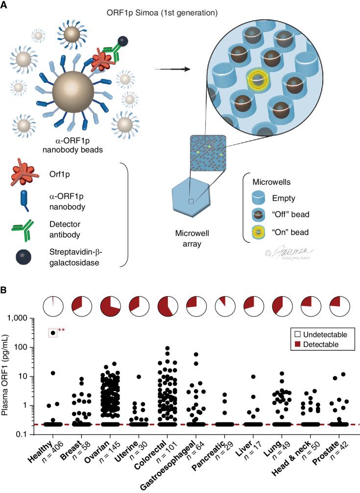 Figure 2. Highly specific detection of carcinomas with the first-generation ORF1p Simoa assay. A, Schematic of single-molecule protein detection by Simoa; a first-generation assay is shown. Antibody/nanobody-coated magnetic beads, present in excess relative to target, capture single target ORF1p molecules; in the first-generation assay, beads are conjugated with α-ORF1p capture nanobody 5 (Nb5). Enzyme-labeled α-ORF1p detection reagent (here, an antibody, Ab6) is added, forming an “immunosandwich,” beads are loaded into microwells that each can hold at most one bead, and ORF1p molecules are then digitally detected using a fluorogenic substrate by counting “on” wells. Illustration: Jennifer E. Fairman, CMI, FAMI. © 2023 Johns Hopkins University, AAM. B, First-generation ORF1p Simoa detects plasma ORF1p with high specificity across major carcinomas. Pie charts indicate the percentage of samples with detectable levels; dashed red line, limit of detection. **, This patient was thought to be “healthy” at the time of blood donation but was six months later found to have prostate cancer and 19 months later found to have lymphoma. (Illustration: Jennifer E. Fairman, CMI, FAMI, © 2023 JHU AAM Department of Art as Applied to Medicine, The Johns Hopkins University School of Medicine).