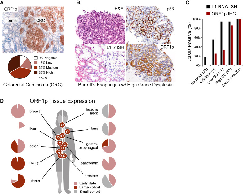 Figure 1. ORF1p expression is early and pervasive in carcinomas. A, ORF1p immunostaining in a cohort of 211 colorectal cancers (CRC). B, Representative BE case: lesional cells overexpress p53, the L1 RNA, and ORF1p. H&E, hematoxylin and eosin; ISH, in situ hybridization. C, L1 RNA and ORF1p overexpression across a cohort of 72 consensus BE cases and 51 carcinomas. GD, grade dysplasia. D, Summary overview of current data on ORF1p tissue expression in carcinomas (by IHC); early data are from Rodić et al. (8), large cohort colon and gastroesophageal and small cohorts (n < 30) are from this study, and large cohort ovarian and uterine are from Pisanic et al. (15) and Xia et al. (24). Large and small cohort ovarian data both showed >90% expression of ORF1p.