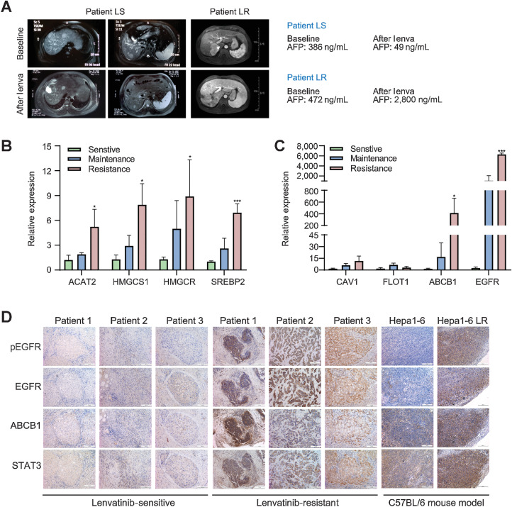 Figure 4. Activation of the EGFR–STAT3–ABCB1 pathway is validated in LR patients and the Hep 1–6 LR mouse model. The efficacy of lenvatinib treatment was evaluated according to RECIST1.1 criteria. In the preoperative efficacy evaluation, patients who reached PD were considered resistant to lenvatinib, and patients who reached PR or SD were considered sensitive to lenvatinib. A, Comparison of liver MRI images and AFP values before and after lenvatinib treatment between a patient in the sensitive group and a patient in the resistant group. B and C, Tissues from patients who reached PR, SD, and PD after lenvatinib treatment were used for validation at the mRNA level. D, IHC staining of liver cancer tissues from patients in the sensitive group and resistant group, and subcutaneous tumor tissues derived from mice that were implanted with the Hep1–6 and Hep1–6 LR strains. All the results are shown as the mean ± SD (n = 5). Two-way ANOVA was used to analyze the data. *, P < 0.05; **, P < 0.01; ***, P < 0.001; ****, P < 0.0001.