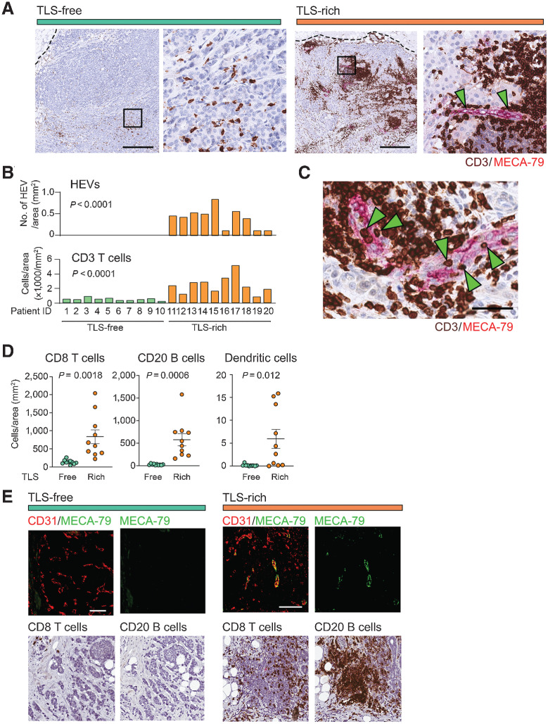 Figure 1. IHC analyses of tumor HEVs and immune-cell infiltration. A, Immunostaining of TLS-rich and TLS-free tumors for MECA-79 (magenta) and CD3 (dark brown) was performed to determine the abundance of HEVs and T cells. The dotted line shows the edge of each tumor. Arrowheads indicate the MECA-79+ HEVs. The higher magnification of each left panel (black square) is shown on the right. Scale bar, 500 µm. B, HEV and CD3+ T-cell densities were quantified in specimens of 10 patients for each tumor type (TLS-rich and TLS-free). C, Immunostaining of CD3 and MECA-79. Green arrowheads indicate several CD3+ cells on or in the endothelial wall of HEVs. Scale bar, 50 µm. D, Comparison of CD8+ T-cell, CD20+ B-cell, and DC-LAMP+ dendritic-cell densities between the two tumor groups analyzed in B. Error bar; SEM. E, Immunofluorescence detection of HEVs associated with lymphocyte clusters in TLS-rich tumors. Consecutive sections of the same tumors were stained for CD31/MECA-79 (immunofluorescence), CD8, or CD20 (dark brown) to orient the positions of immune cells and blood vessels. A representative TLS is shown here for TLS-rich tumors. CD31, EC marker (red). Scale bar, 500 µm. P value was calculated by Student t test.