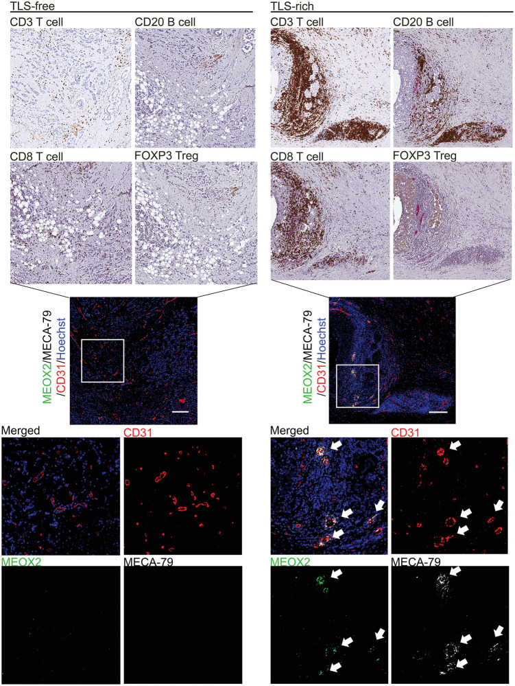 Figure 5. Immunostaining of MEOX2 identifies tumor HEVs associated with TLS in human breast cancer. IHC staining of different lymphocyte markers was conducted in serial tumor sections to visualize infiltration of T cells, B cells, and Tregs in TLS-free and TLS-rich breast cancer (brown staining, top). Tumor specimens of 10 patients were examined for each tumor type (TLS-rich and TLS-free). These tumor specimens were from the same patients assessed in Fig. 1. Tumor sections were also costained with MECA-79 antibodies (white) to highlight HEVs. The consecutive sections of the same tumors were analyzed by immunofluorescence of MEOX2, MECA-79, and CD31 (center and bottom). Hoechst, nuclear staining (blue). The data shown are for 1 patient representative of each tumor type. Scale bar, 200 µm. Areas in the white squares are enlarged in the bottom plots.