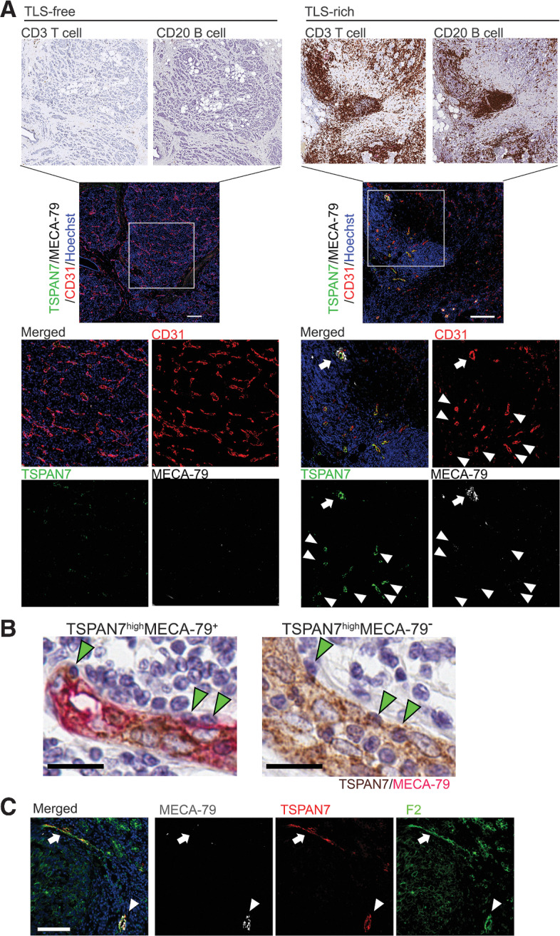 Figure 6. TSPAN7+MECA-79– tumor vessels are associated with lymphocyte clustering and found in TLS. A, IHC staining of different lymphocyte markers was conducted in serial tumor sections to visualize infiltration of T cells, B cells, and Tregs in TLS-free and TLS-rich breast cancer. Tumor specimens of 10 patients were examined for each tumor type (TLS-rich and TLS-free). These tumor specimens were from the same patients assessed in Fig. 1. The consecutive sections of the same tumors were analyzed by immunofluorescence for TSPAN7, MECA-79, and CD31 (lower panels). TSPAN7+MECA-79+ double-positive HEVs (arrows) and TSPAN7+MECA-79– vessels (arrowheads) are both localized in TLS. For the IHC image of the TLS-free tumor, a lower magnification of Fig. 1E is shown. The data shown are for 1 patient representative of each tumor type. Scale bar, 200 µm. B, Immunostaining of MECA-79 (red) and TSPAN7 (brown) in a TLS-rich breast cancer specimen. Leukocytes engrafted in the endothelial wall of TSPAN7highMECA-79+ and TSPAN7highMECA-79– blood vessels are shown. Scale bar, 20 µm. C, Immunostaining of TSPAN7, MECA-79, and sLeX (by F2 antibody) in TLS-rich tumor sections. Arrows show TSPAN7+MECA-79– vessels detected by the F2 antibody. Arrowhead, TSPAN7+MECA-79+ vessels. A representative image of four TLS-rich tumor samples is shown. Scale bar, 100 µm.