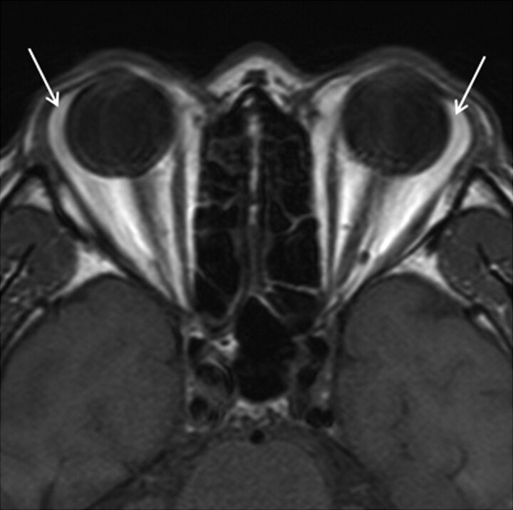 Subconjunctival Fat Prolapse and Dermolipoma of the Orbit ...