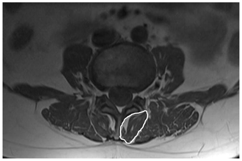 Criterion Validity of Ultrasound Imaging: Assessment of Multifidi Cross ...