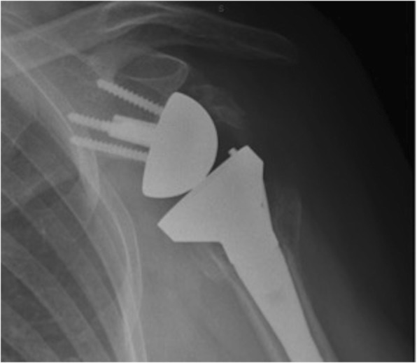 Reverse Shoulder Arthroplasty Vs Bio-rsa: Clinical And Radiographic 