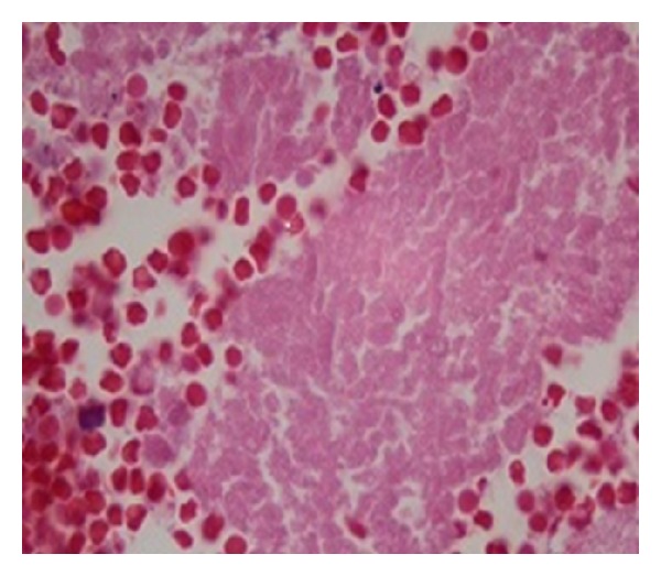 Small cell lung cancer presenting as severe thrombocytopenia and