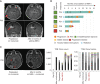 Figure 4. Patients treated with nivolumab and trametinib (n = 5). A, Objective responses in bifocal glioblastoma progressing on nivolumab. B, Swimmer's plot summarizing events in each patient. C, The patient progressing at primary and distant sites on nivolumab had complete response on being simultaneously treated with radiation and addition of trametinib to nivolumab. T-cell receptor (TCR) clonotype analysis shows an initial increase in TCRB after starting on nivolumab, and invigoration of response at salvage treatment postprogression. This was observed both in terms of increased absolute clonal counts after adding trametinib, as well as clonal selection, plausibly for more tumor-specific TCR clones (as shown by the colored bars), as this correlated with the response seen in radiology. MEK-i, MEK inhibitor.